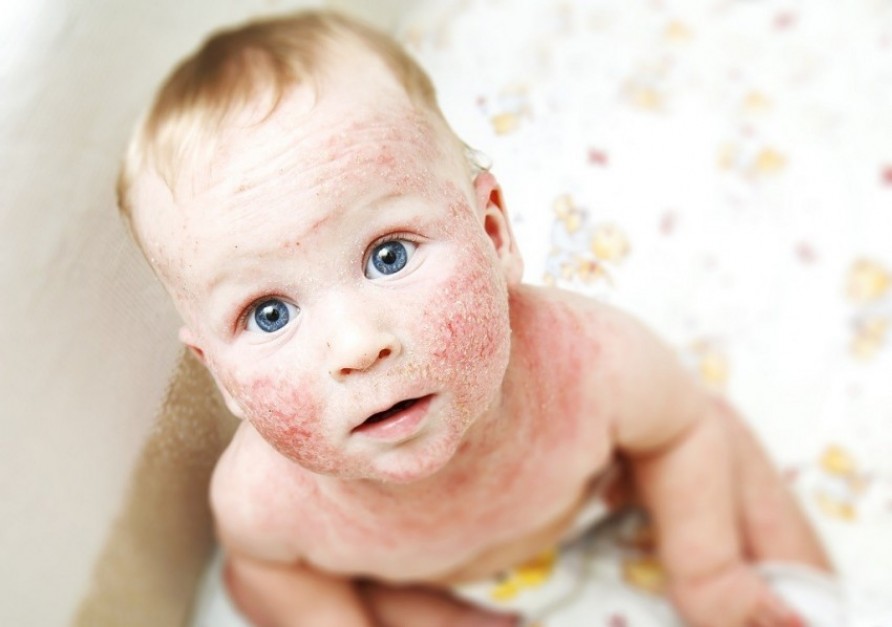 Виды аллергических сыпей у детей