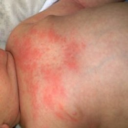 Способы лечения аллергической сыпи у ребенка