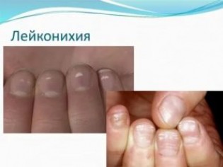 Лейконихия: виды, причины, симптомы и лечение ногтей
