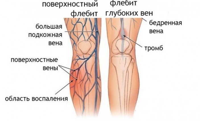 Виды и признаки шишек на ногах