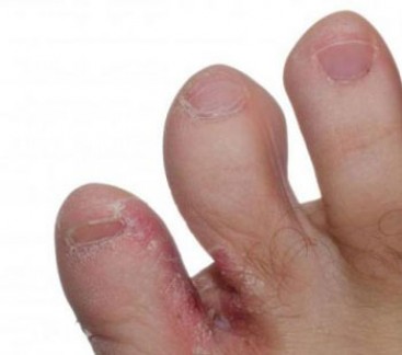 Причины кожного зуда между пальцами ног