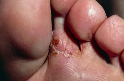 Как лечить зуд пальцев ног?