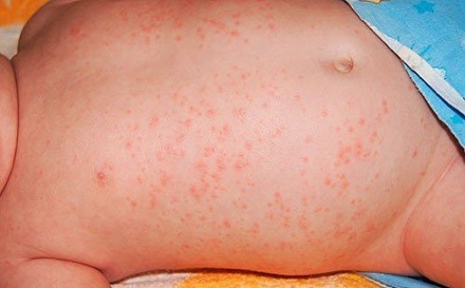 Особенности аллергического дерматита у детей