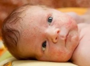 Везикулопустулез у детей: что это такое, какие причины возникновения у новорожденных, как лечить?