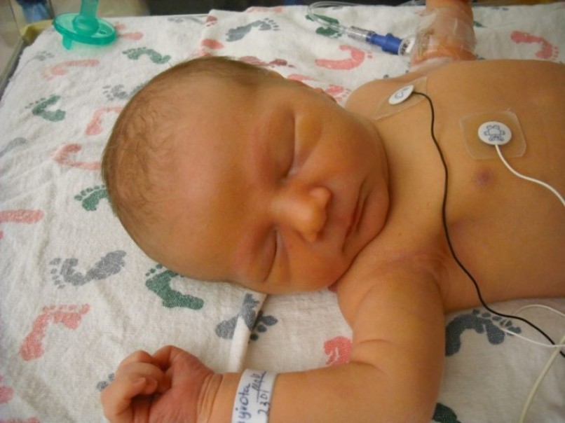Причины желтухи у новорожденных