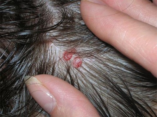 Как выглядят укусы вшей на теле и чем лечить?