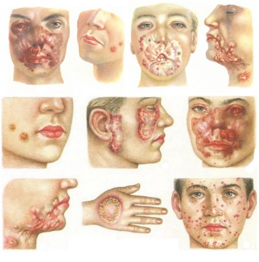 Причины возникновения туберкулеза кожи