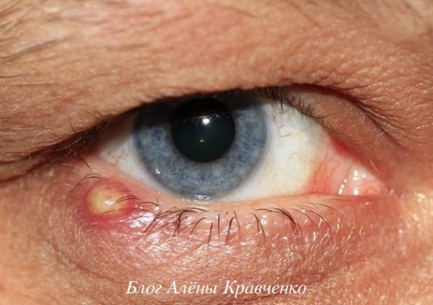 Ячмень на глазу — симптомы возникновения заболевания 