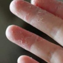 Почему слезает кожа на пальцах рук?