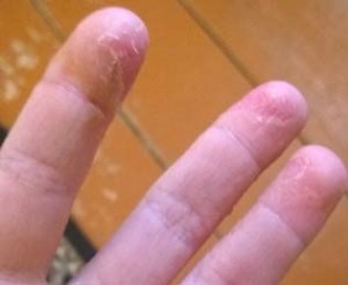 Облезает кожа на пальцах рук, какими болезнями это вызвано?