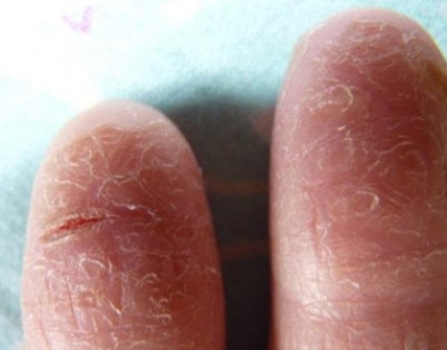 Облезает кожа на пальцах рук, какими болезнями это вызвано?