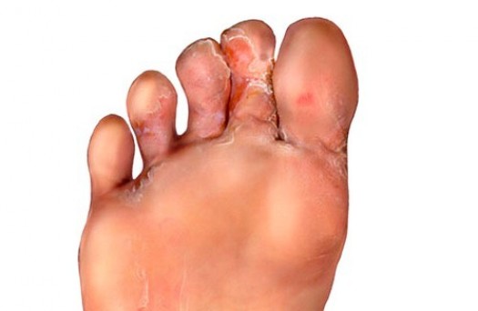 Грибок между пальцами ног лечение народными средствами