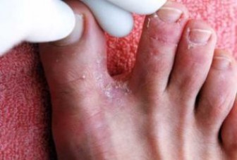 Почему облазит кожа между пальцами ног?
