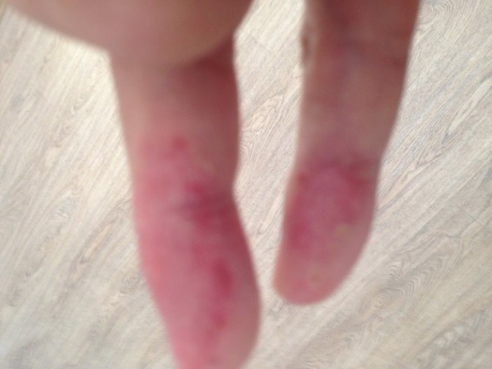 Причины шелушения кожи на пальцах рук