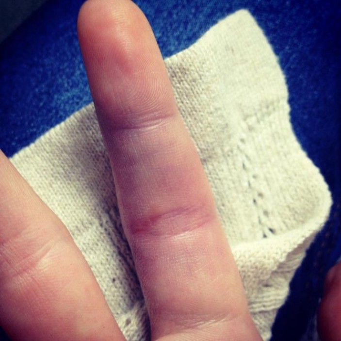 Признаки травмы пальца руки
