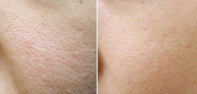 Польза ацетилсалициловой кислоты для кожи лица