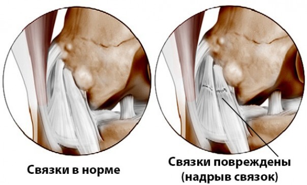 Надрыв связок колена: лечение