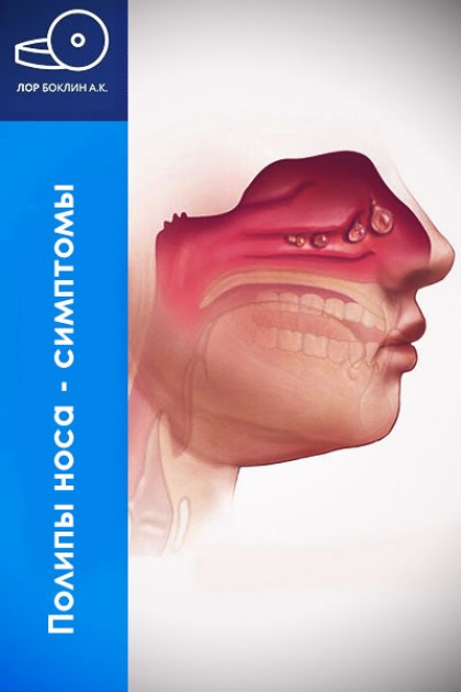 Носовые полипы: симптомы