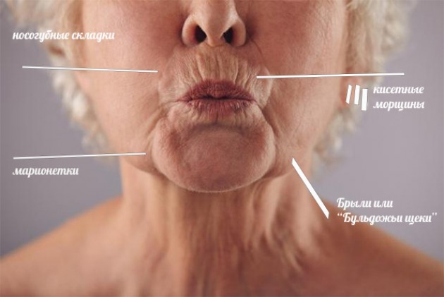 От чего появляются морщины в области рта?