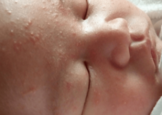 Опрелость — это заболевание кожи новорожденного ребенка, возникшее в местах избыточного трения, на участках, длительно подвергавшихся воздействию мочи и кала, в складочках кожи.