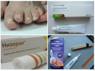 Мазь Унисан: инструкция по применению для людей при грибке ногтей