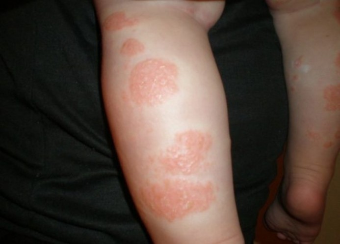 Аллергическая сыпь и красные пятна у взрослых