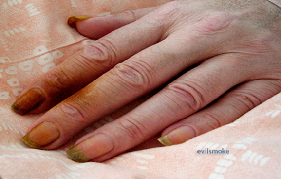 Варианты лечения желтых ногтей