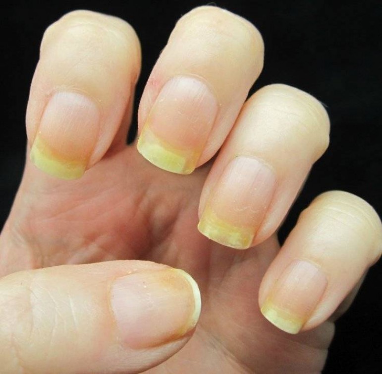 Варианты лечения желтых ногтей