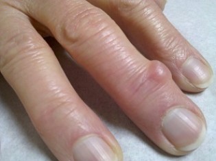Шишки на пальцах рук: причины развития и лечение