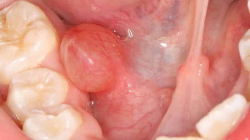 Рак под языком