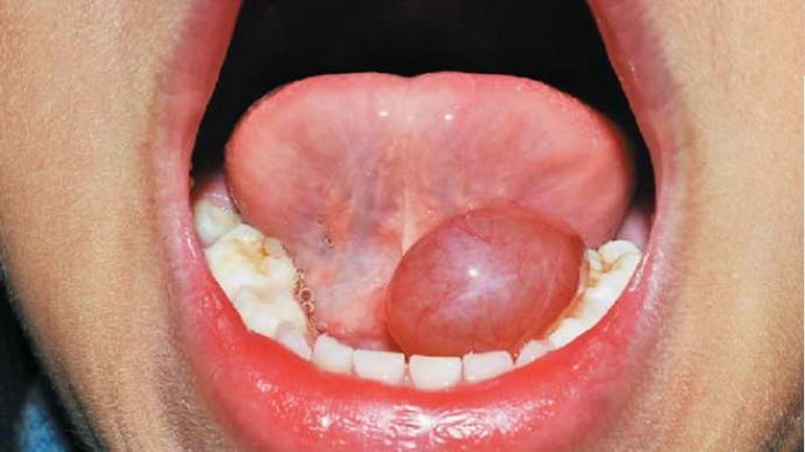 Почему вылезла шишка на губе – природа симптоматики и методы терапии