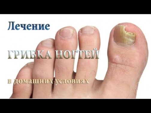 Народные средства для лечения грибка на ногтях ног