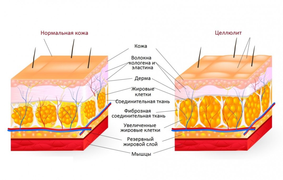 Причины появления фиброзной формы целлюлита