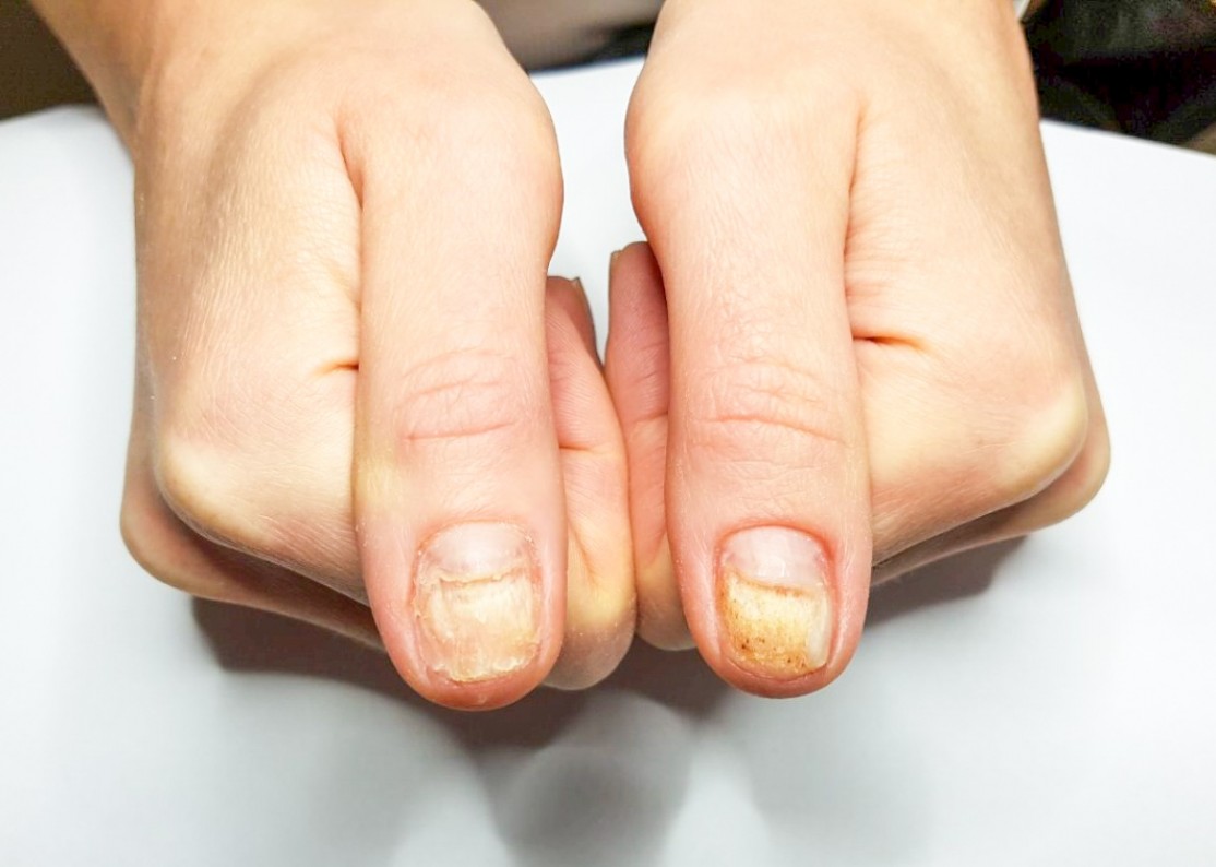 Лечение и профилактика желтизны ногтей