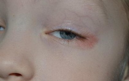 Покраснение кожи вокруг глаз: как с этим бороться?