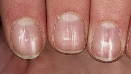 Как лечить ногти?