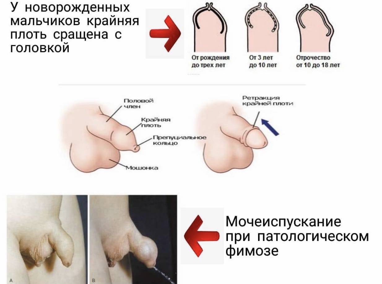 Патологический фимоз: что это такое и как лечить 