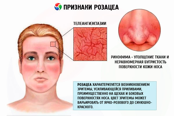 Розацеа: таблетки и мази от розовых угрей на лице