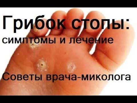Грибок стоп: фото, симптомы, лечение