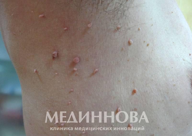 Мазь от папиллом: какое средство лучше?