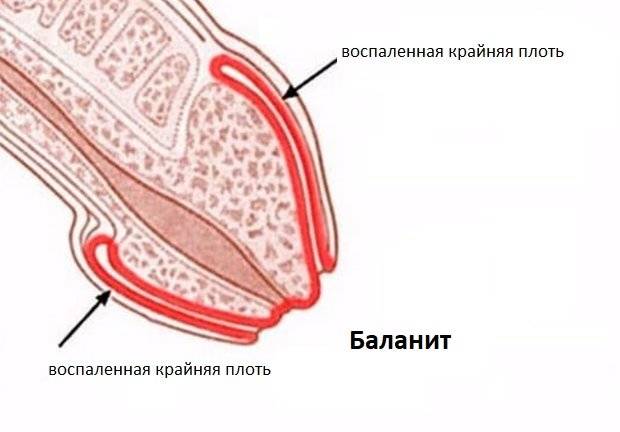 Баланит и баланопостит: способы лечения и рекомендации