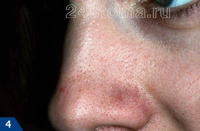 Личный опыт: как я вылечила прыщи