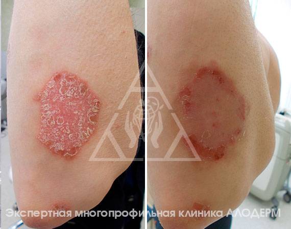 Передается ли псориаз от родителей детям и с какой вероятностью?