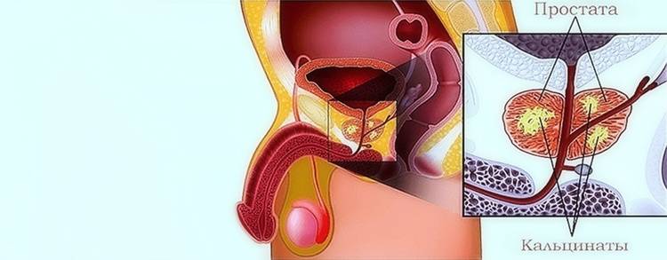 Предстательная железа сок