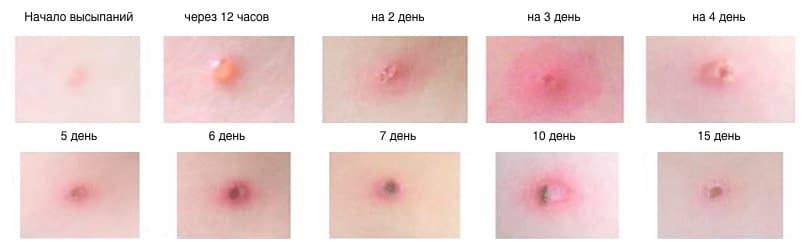 Как передается ветрянка у детей и в домашних условиях