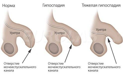 Гипоспадия у мальчиков
