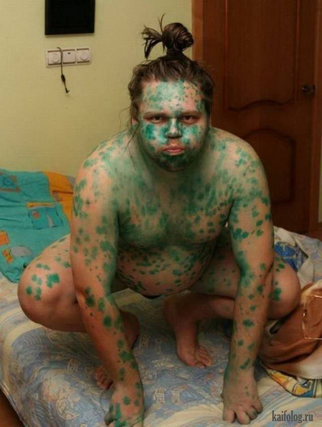 Прыщи на спине симптом вич