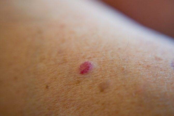 Папилломы: виды, причины появления, особенности диагностики и лечения