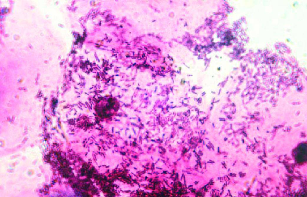 Молочница бактерии. Бактериальный вагиноз микроскопия мазка. Бактериальный вагиноз мазок микроскопия. Ключевые клетки мобилункус. Мобилункус гарднереллы.