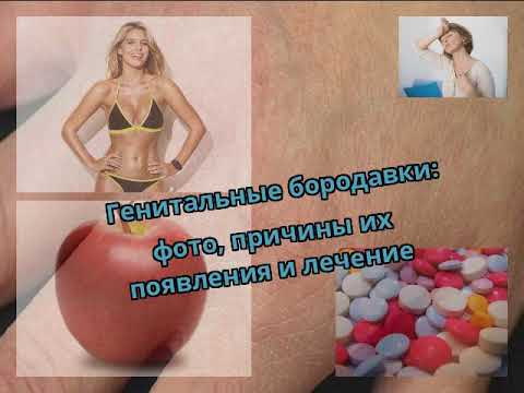 Папилломы на интимных местах: причины, лечение и особенности